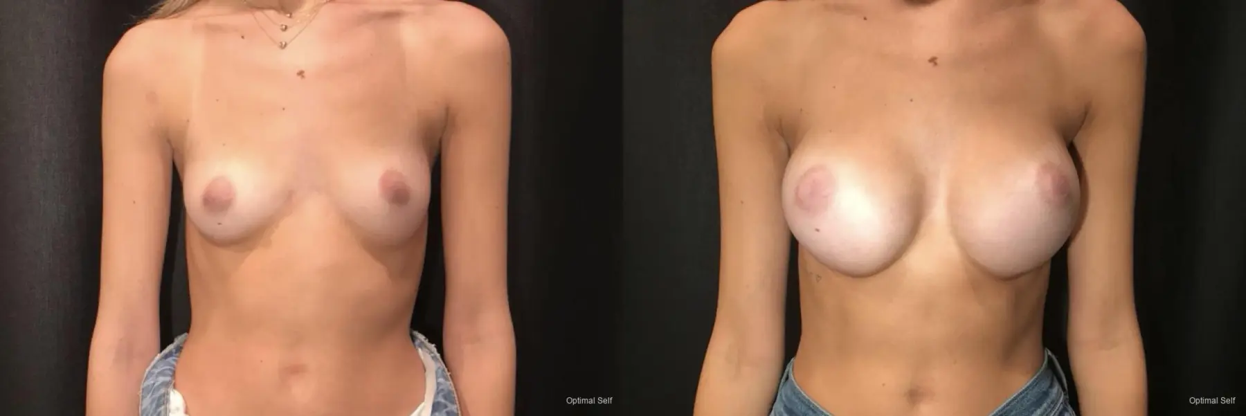 Breast Augmentation: Patient 1 - Before and After  