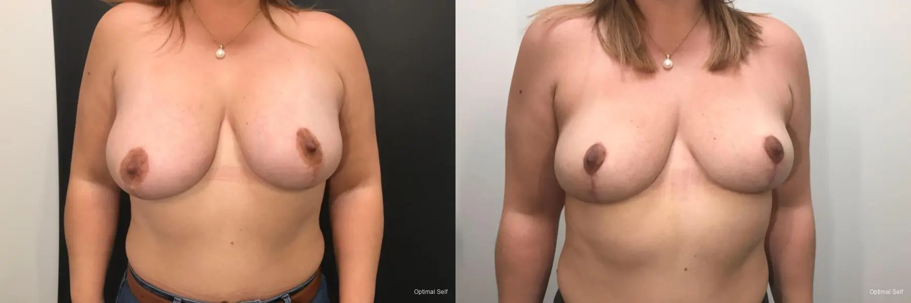 Breast Implant Removal With Lift: Patient 3 - Before and After  