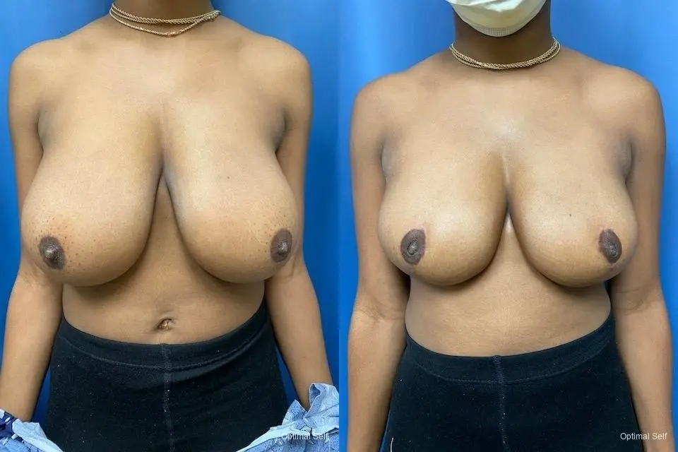 Breast Reduction: Patient 3 - Before and After  