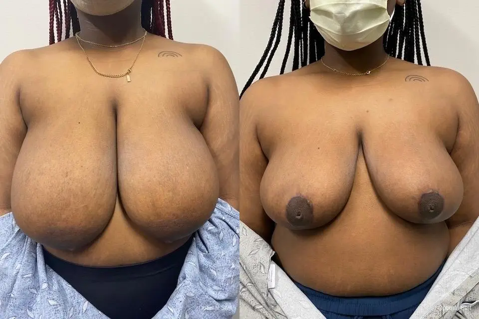 Breast Reduction: Patient 4 - Before and After  