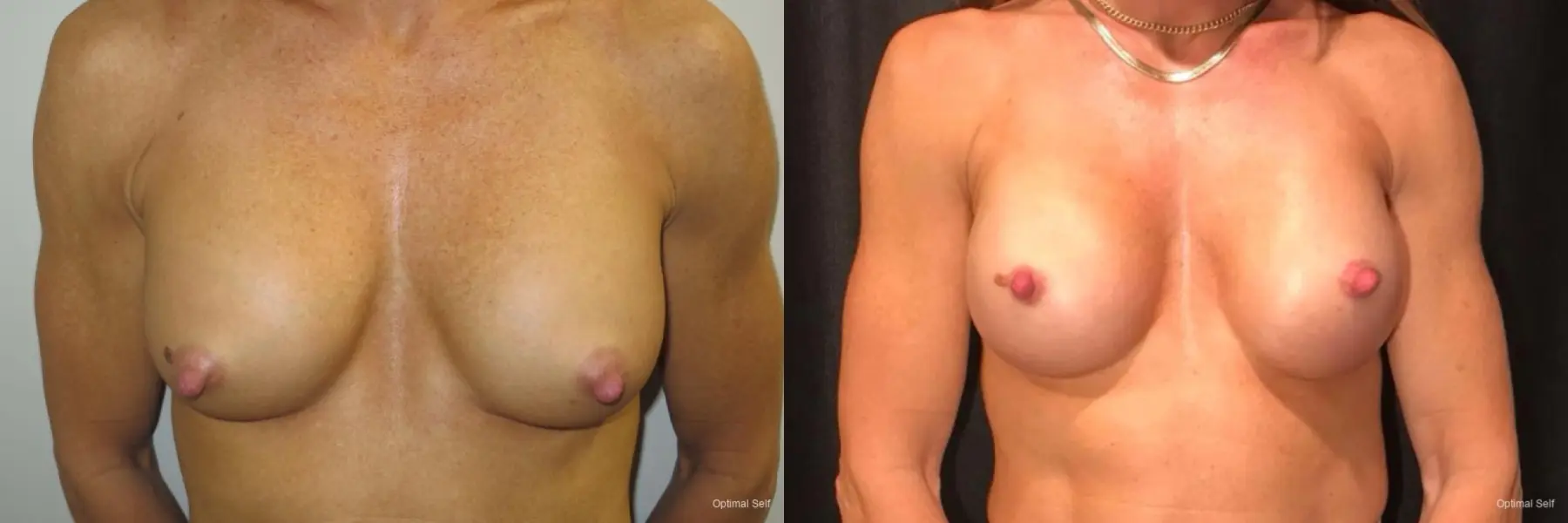 Breast Revision: Patient 1 - Before and After  