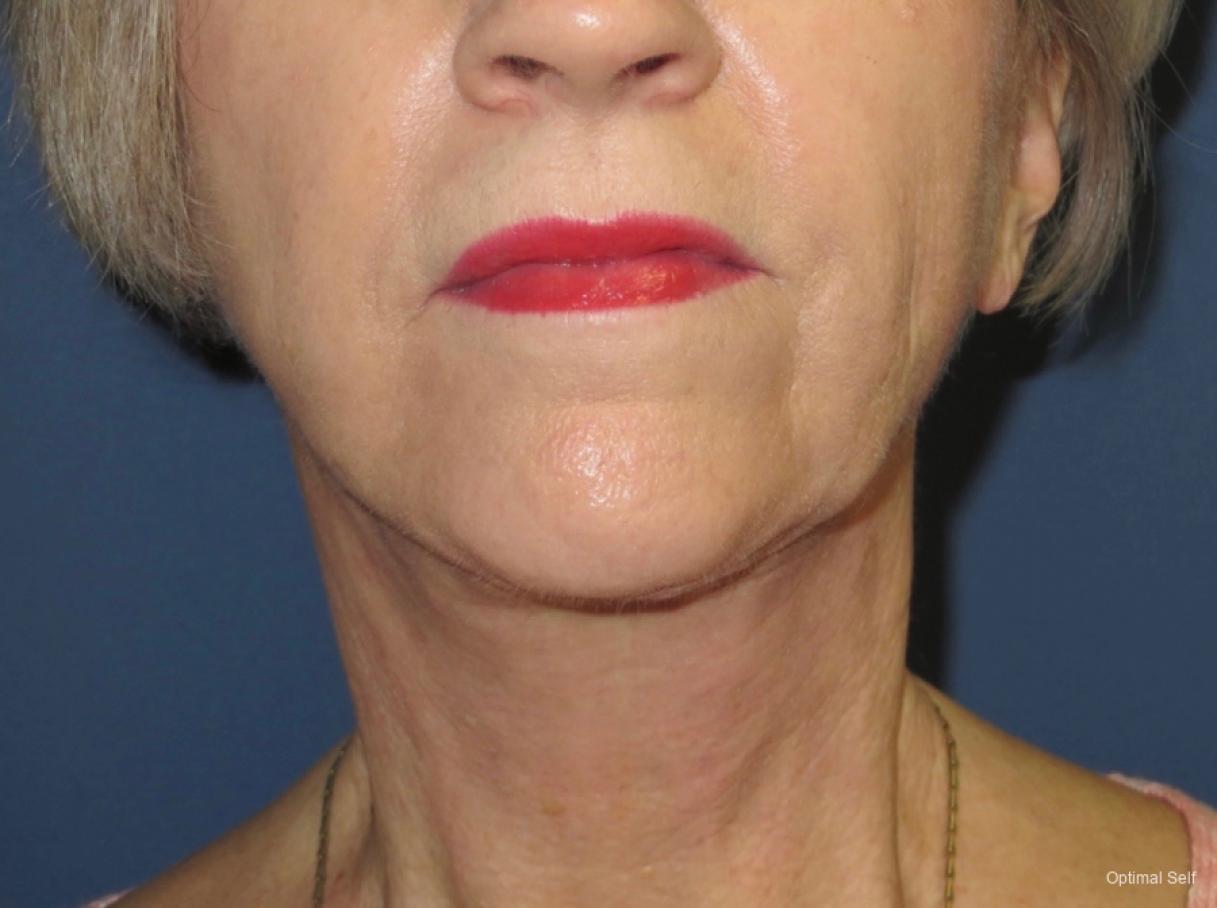 Neck Lift: Patient 1 - After  