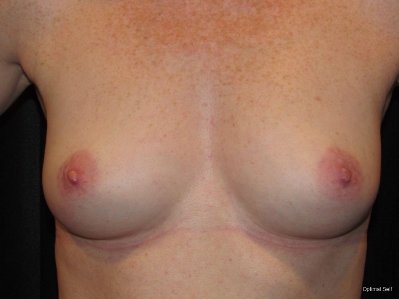 Breast Augmentation: Patient 6 - Before 1