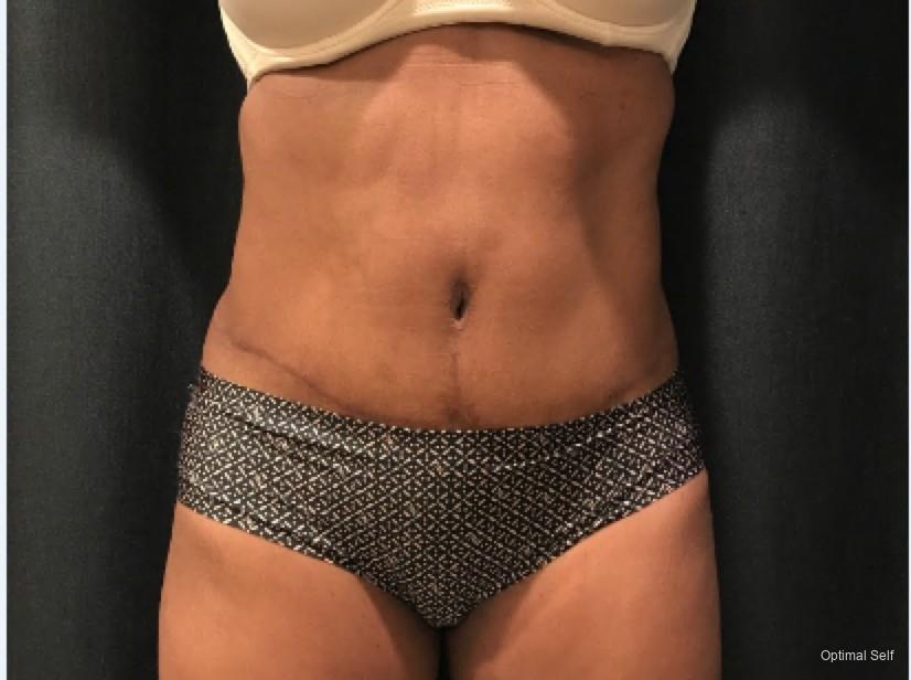 Abdominoplasty: Patient 6 - After  