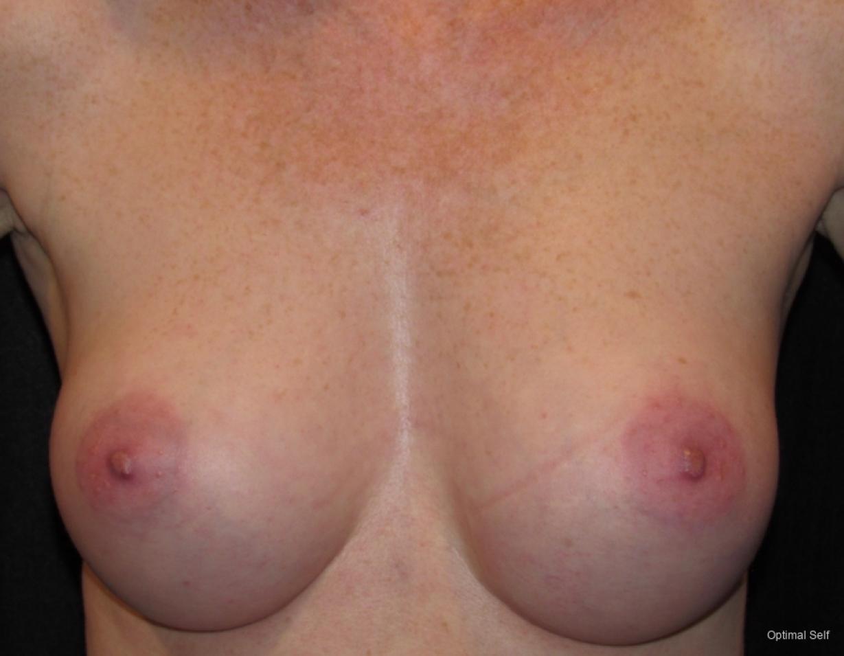 Breast Augmentation: Patient 11 - After 
