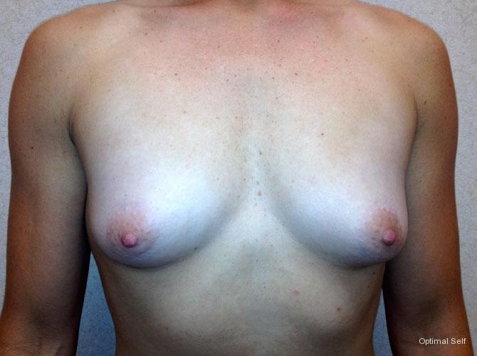 Breast Augmentation: Patient 1 - Before 
