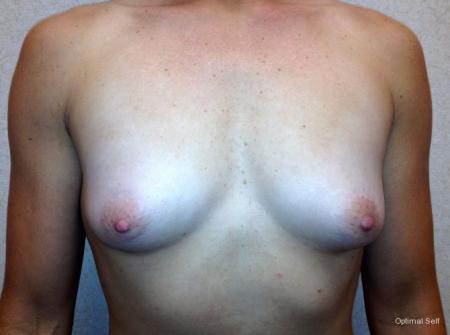 Breast Augmentation: Patient 1 - Before 