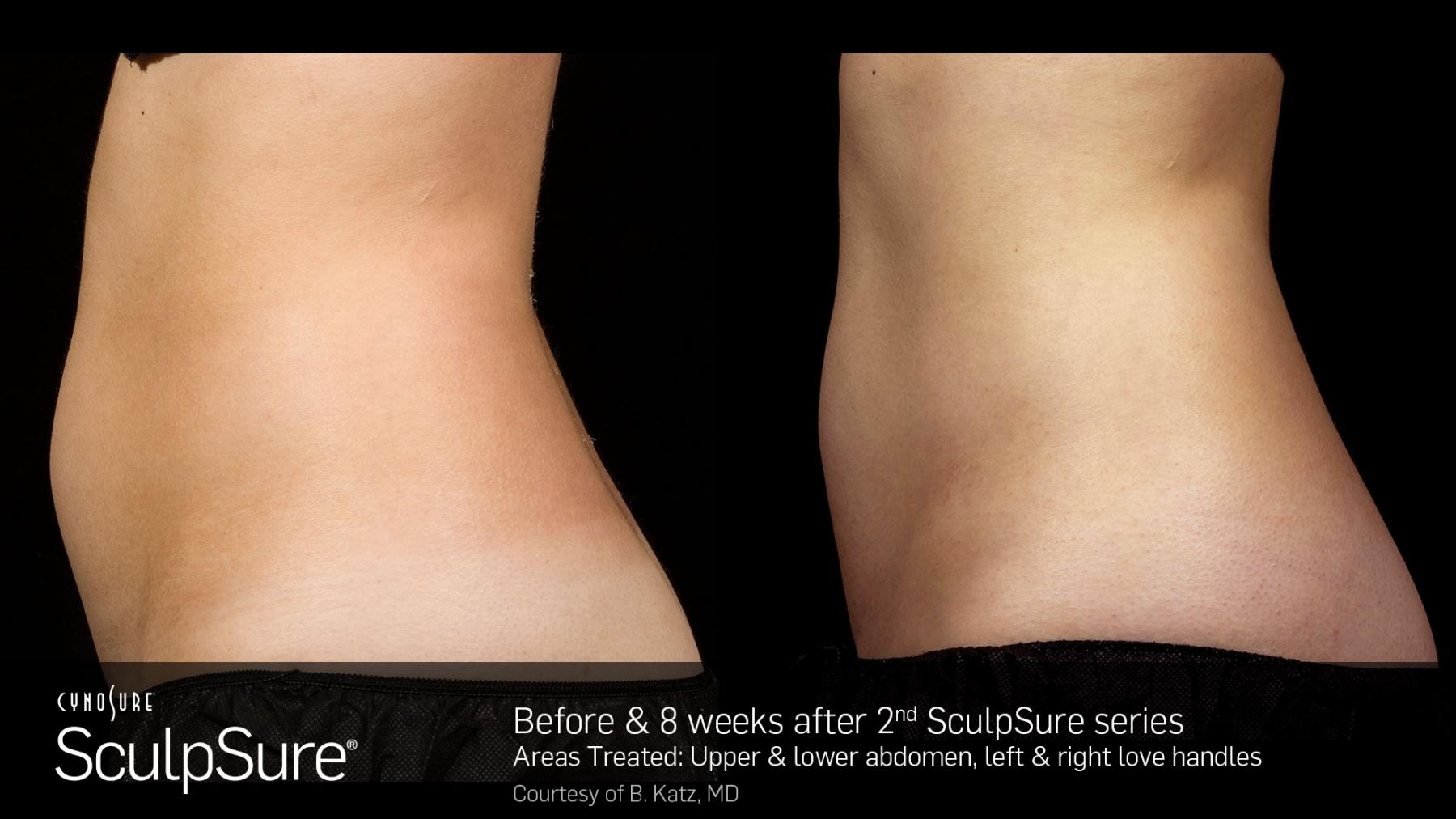 SculpSure™: Patient 4 - Before and After  
