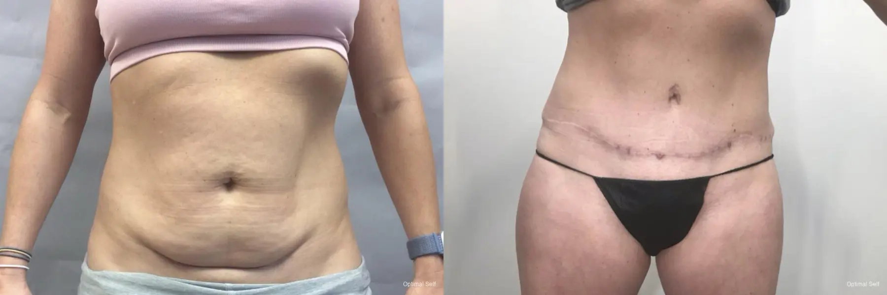 Liposuction: Patient 5 - Before and After  