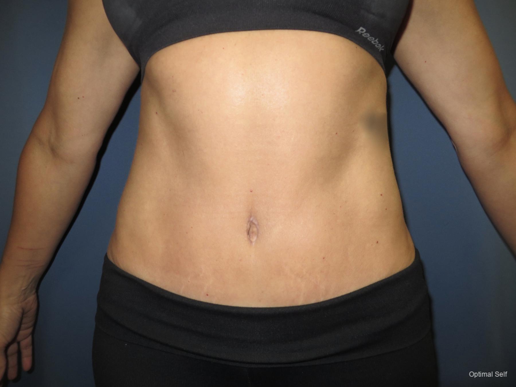Abdominoplasty: Patient 2 - After  