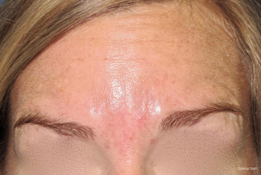 BOTOX® Cosmetic: Patient 2 - After  