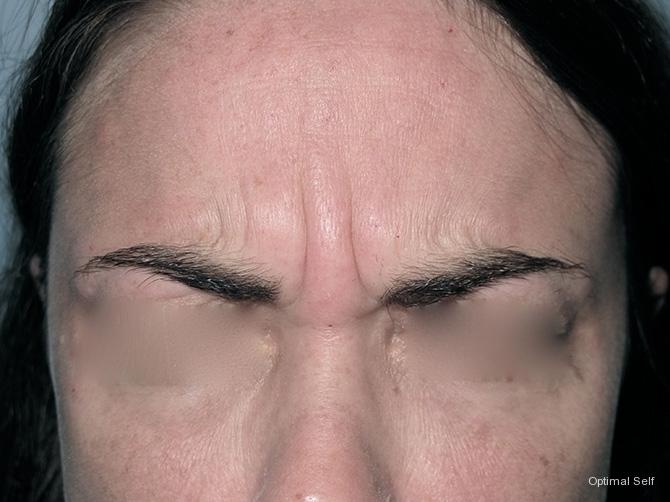 BOTOX® Cosmetic: Patient 1 - Before 