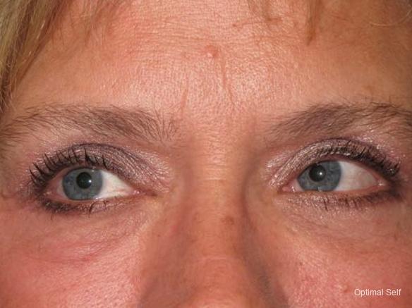 Eyelid Lift: Patient 4 - After  