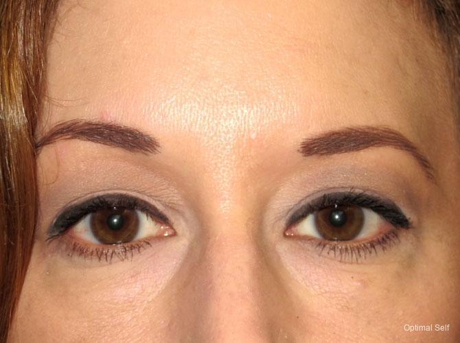 Eyelid Lift: Patient 1 - Before 