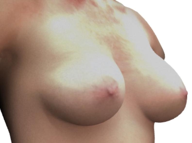 Breast Augmentation: Patient 6 - After 2_2