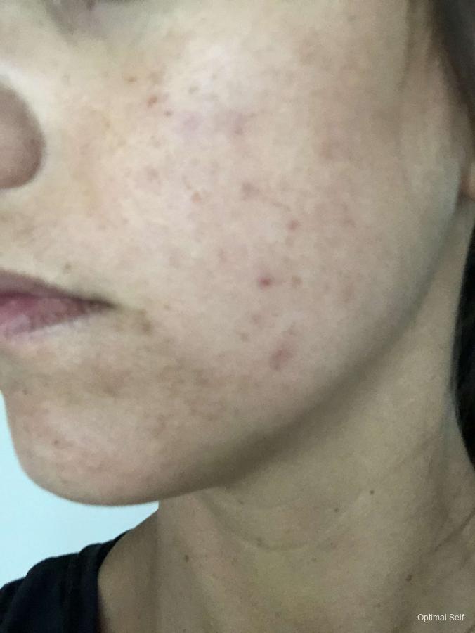 Acne Scars: Patient 1 - Before and After  
