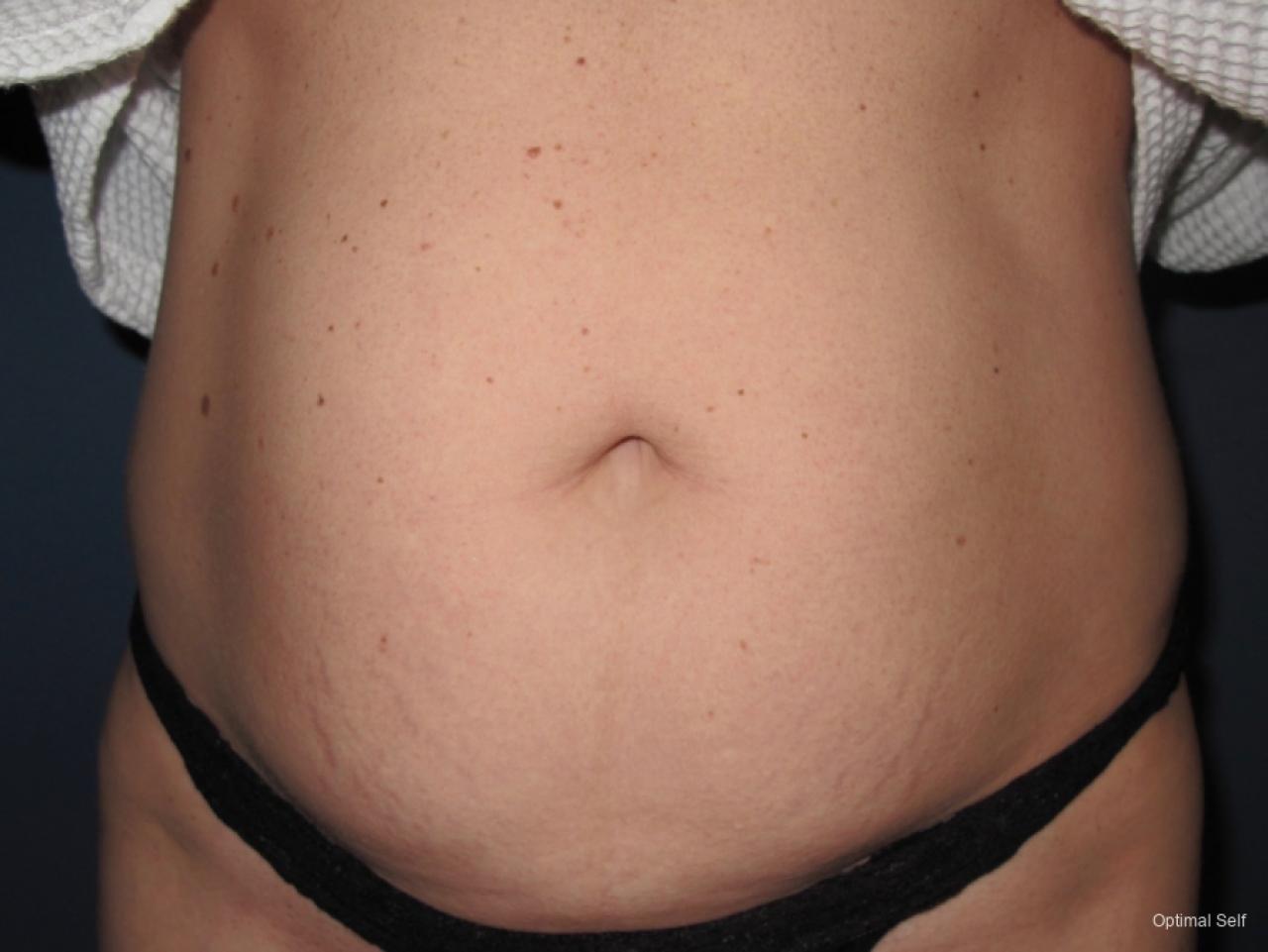 Liposuction: Patient 4 - Before 