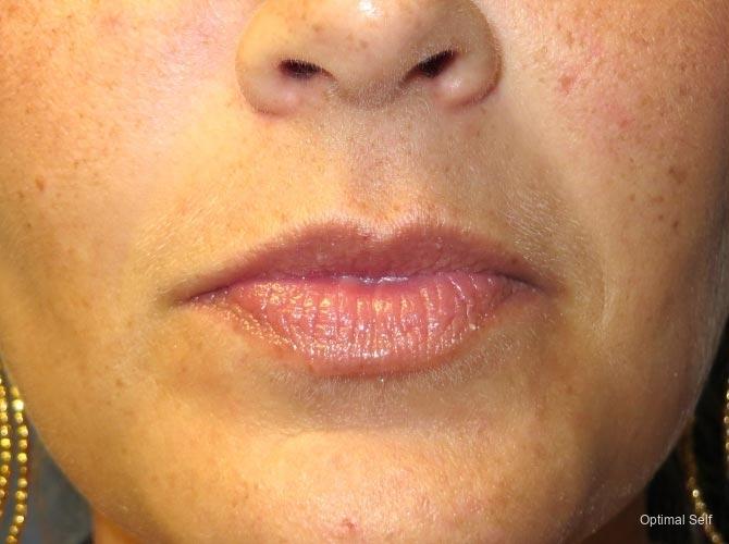 Juvederm: Patient 1 - After  