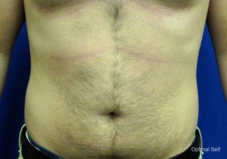 Liposuction: Patient 1 - Before 