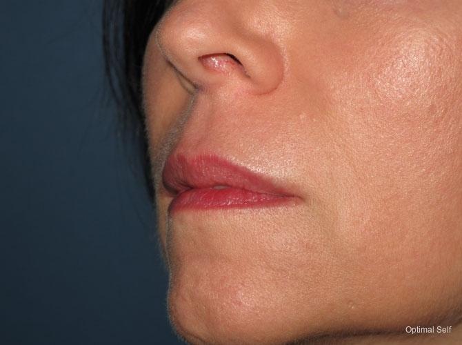 Juvederm: Patient 2 - After  