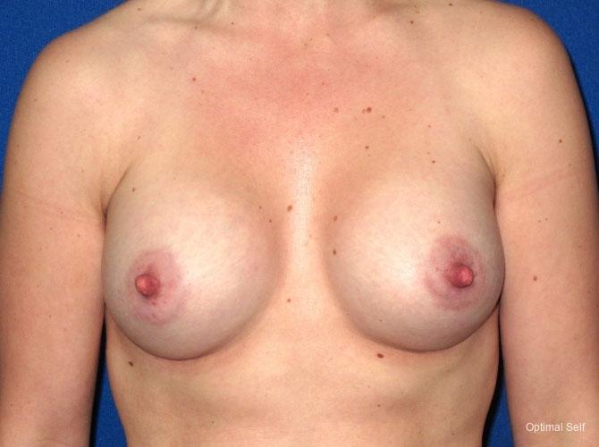 Breast Augmentation: Patient 2 - After  