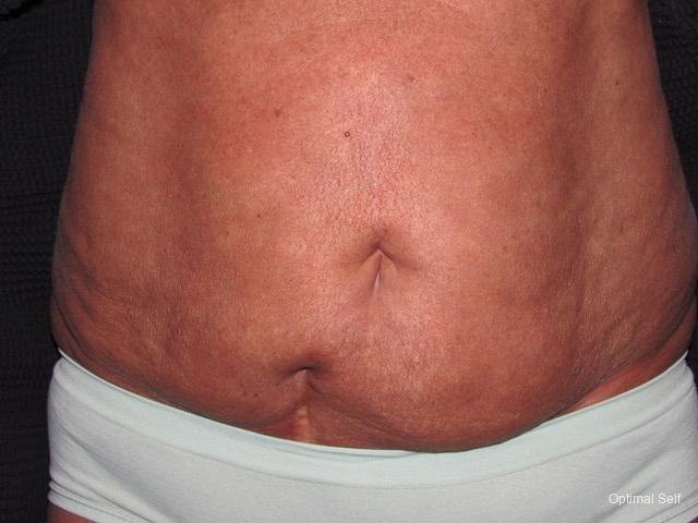 Abdominoplasty: Patient 3 - After  