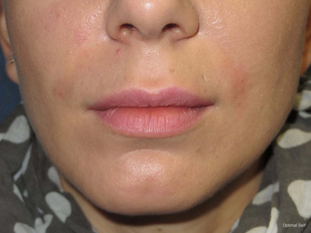 Juvederm: Patient 5 - After  