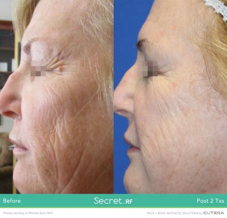 Secret RF: Patient 6 - After  