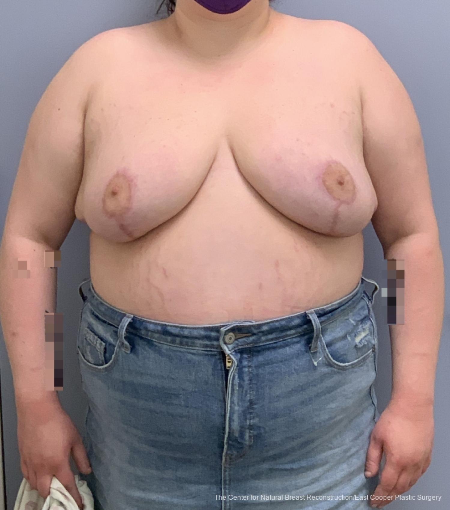 Breast Reduction: Patient 2 - After 1