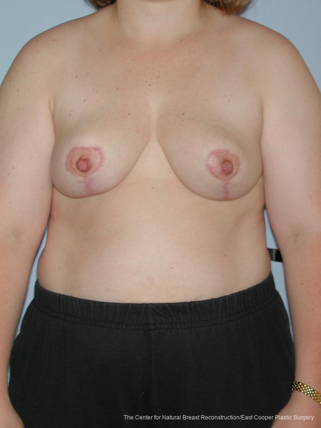 Breast Reduction: Patient 3 - After  