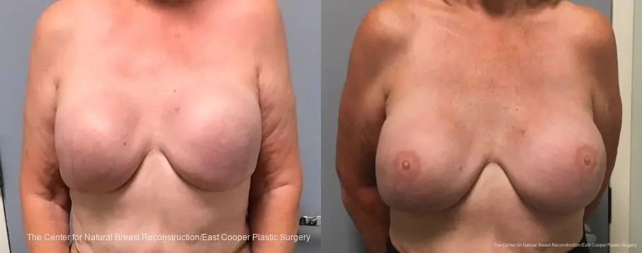 3-D Nipple Tattoo - Before and After 1