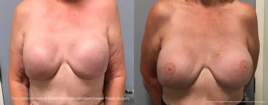 3-D Nipple Tattoo - Before and After