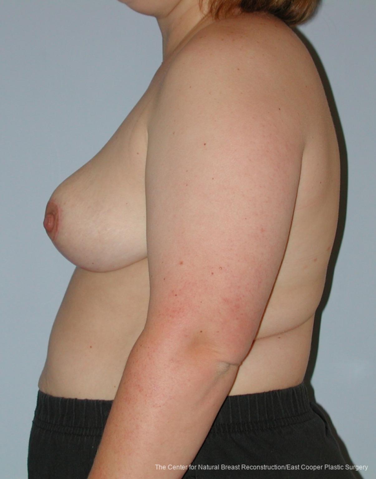 Breast Reduction: Patient 3 - After 2