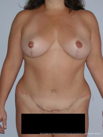 Tummy Tuck: Patient 5 - After  