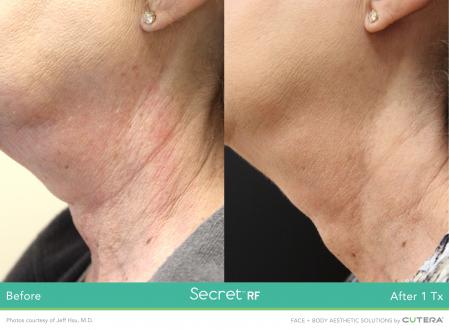 Secret RF: Patient 5 - After  