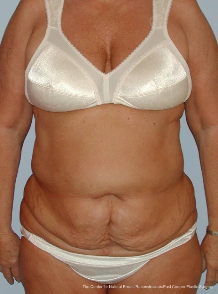 Tummy Tuck: Patient 9 - Before 1