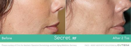 Secret RF: Patient 4 - After  