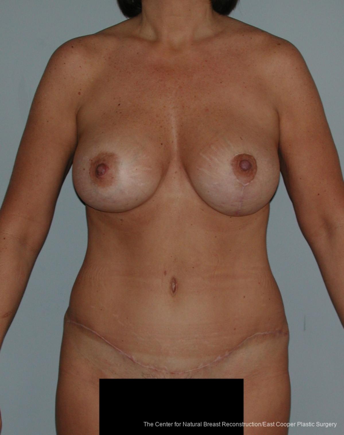 Tummy Tuck: Patient 3 - After  