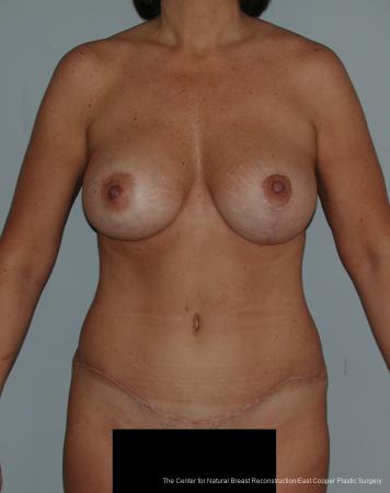 Tummy Tuck: Patient 3 - After  
