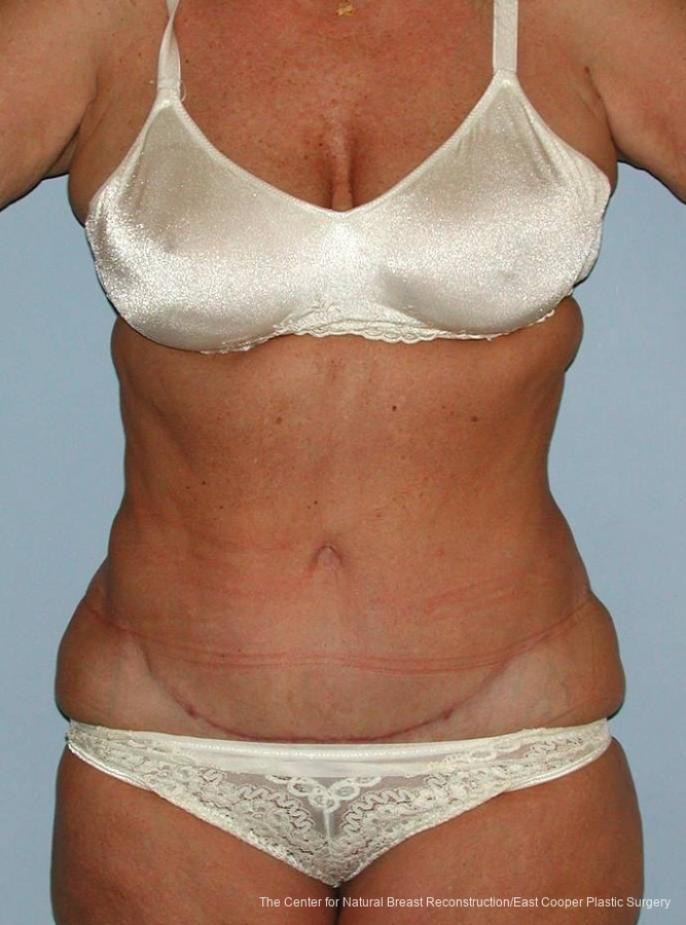 Tummy Tuck: Patient 9 - After 1