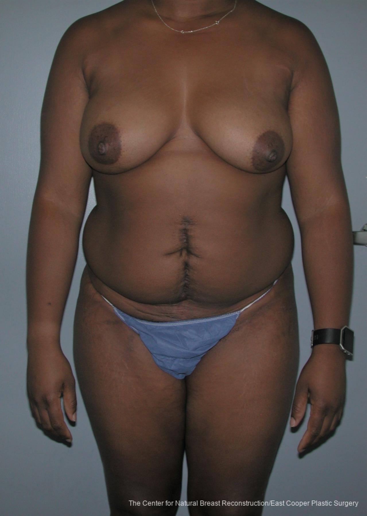Breast Reconstruction DIEP: Patient 10 - Before 1