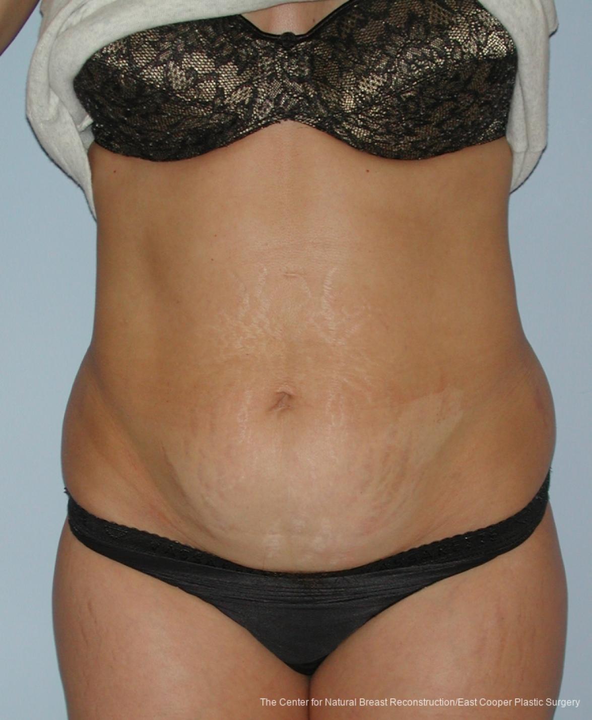 Tummy Tuck: Patient 7 - Before 1
