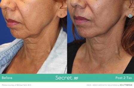 Secret RF: Patient 5 - Before 