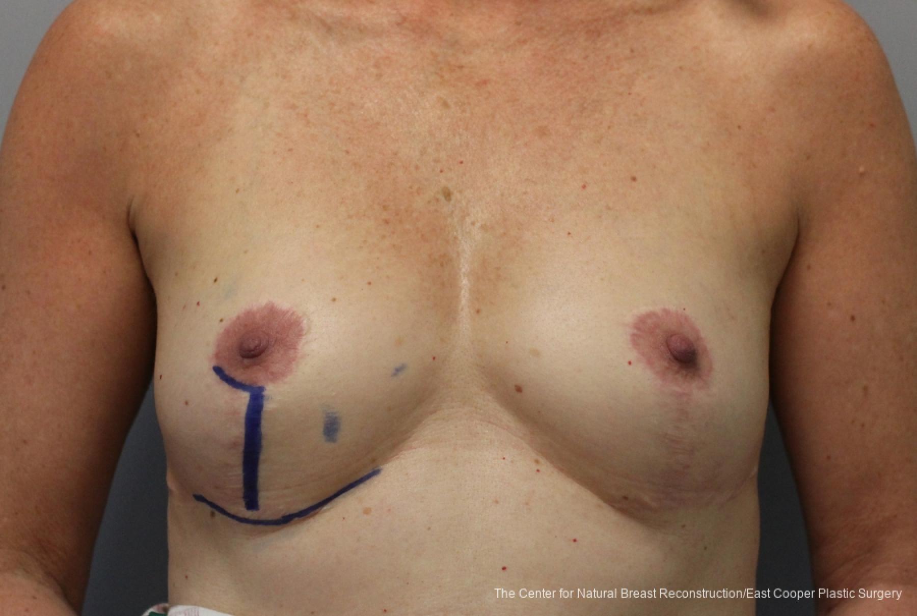Breast Reconstruction: Patient 9 - Before 1