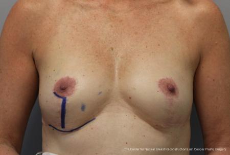 Breast Reconstruction: Patient 9 - Before 