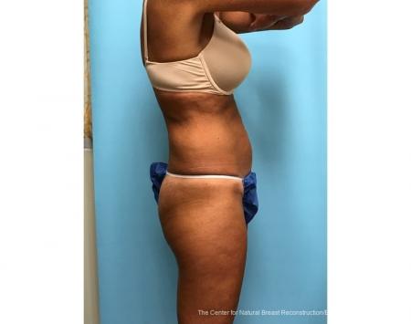 TruSculptiD: Patient 3 - After  