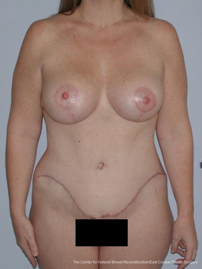 Tummy Tuck: Patient 10 - After  