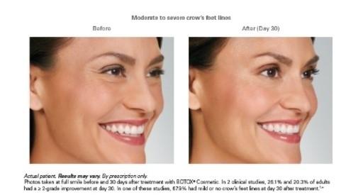 BOTOX® Cosmetic: Patient 2 - Before 