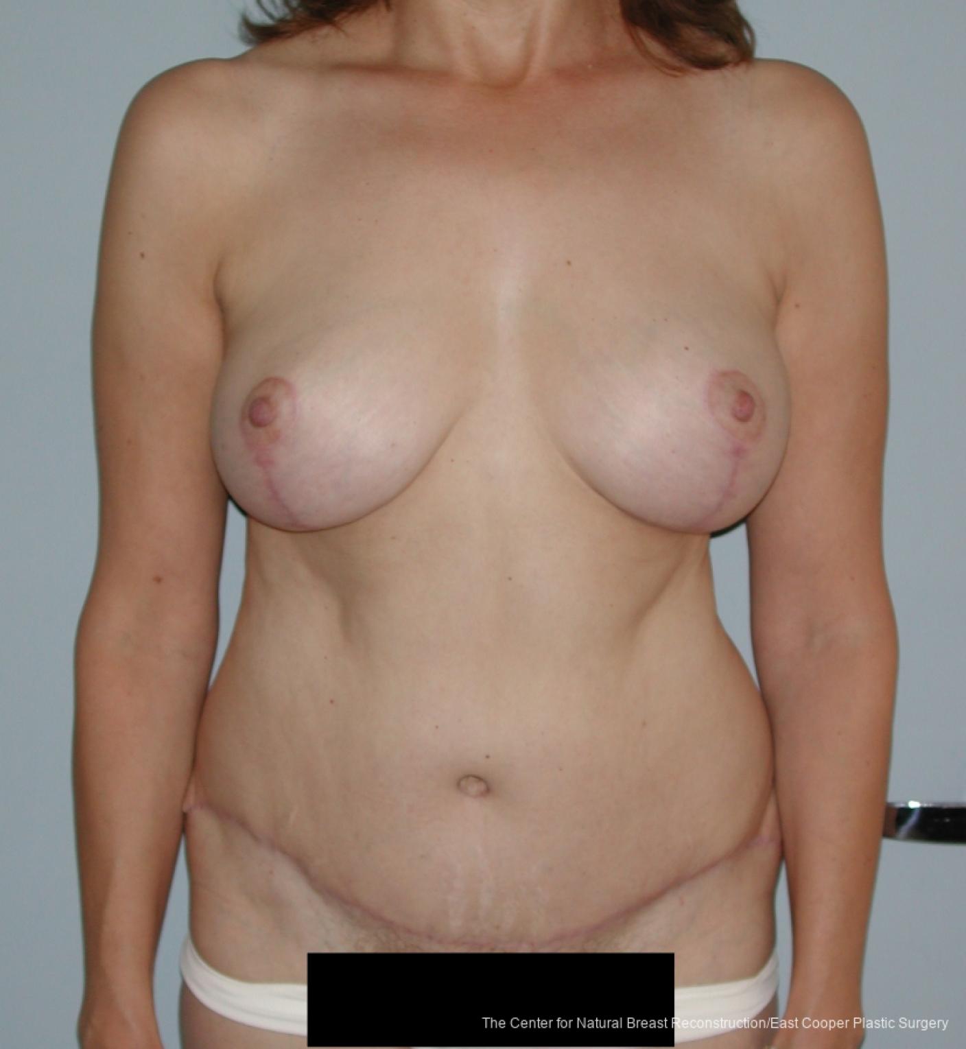 Tummy Tuck: Patient 6 - After  