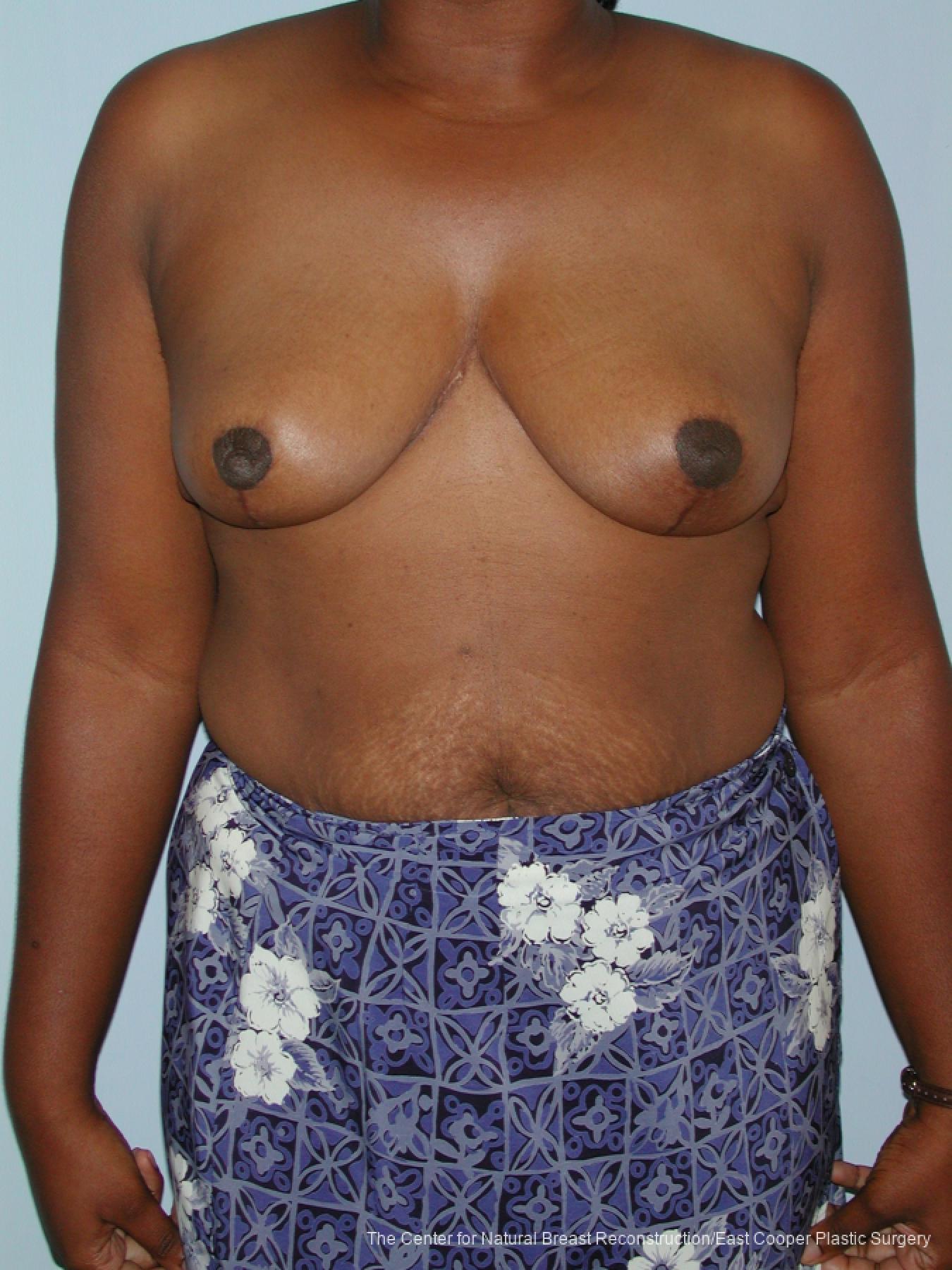 Breast Reduction: Patient 8 - After 1